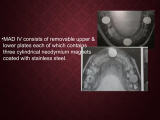 •MAD IV consists of removable upper &
lower plates each of which contains
three cylindrical neodymium magnets
coated with stainless steel.
 