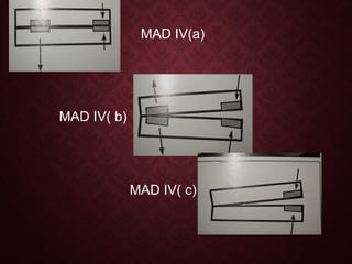MAD IV(a)
MAD IV( b)
MAD IV( c)
 
