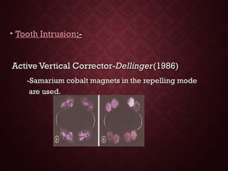 • Tooth IntrusionTooth Intrusion:-:-
Active Vertical Corrector-Active Vertical Corrector-DellingerDellinger(1986)(1986)
-Samarium cobalt magnets in the repelling mode-Samarium cobalt magnets in the repelling mode
are used.are used.
 