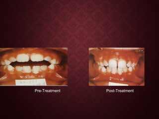 Pre-Treatment Post-Treatment
 