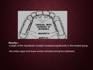 Results:-
-Length of the mandibular condyle increased significantly in the treated group.
-the entire upper and lower arches intruded during the treatment.
 