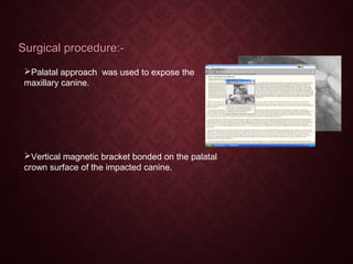 Surgical procedure:-Surgical procedure:-
Palatal approach was used to expose the
maxillary canine.
Vertical magnetic bracket bonded on the palatal
crown surface of the impacted canine.
 