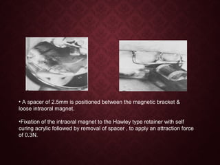 • A spacer of 2.5mm is positioned between the magnetic bracket &
loose intraoral magnet.
•Fixation of the intraoral magnet to the Hawley type retainer with self
curing acrylic followed by removal of spacer , to apply an attraction force
of 0.3N.
 