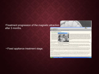 •Treatment progression of the magnetic attraction
after 3 months.
• Fixed appliance treatment stage.
 
