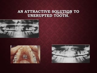 AN ATTRACTIVE SOLUTION TOAN ATTRACTIVE SOLUTION TO
UNERUPTED TOOTH.UNERUPTED TOOTH.
-Sandler(1991)
 