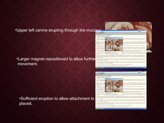 •Upper left canine erupting through the mucosa.
•Larger magnet repositioned to allow further
movement.
•Sufficient eruption to allow attachment to be
placed.
 