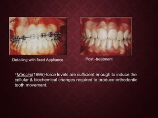 Detailing with fixed Appliance. Post -treatment
ManciniMancini(1996)-force levels are sufficient enough to induce the(1996)-force levels are sufficient enough to induce the
cellular & biochemical changes required to produce orthodonticcellular & biochemical changes required to produce orthodontic
tooth movement.tooth movement.
 