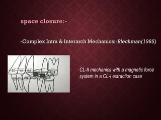 space closure:-space closure:-
-Complex Intra & Interarch Mechanics:--Complex Intra & Interarch Mechanics:-Blechman(1985)Blechman(1985)
CL-II mechanics with a magnetic force
system in a CL-I extraction case
 