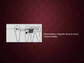 Intramaxillary magnetic force to move
Canine distally.
 