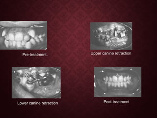 Pre-treatment. Upper canine retraction
Lower canine retraction Post-treatment
 