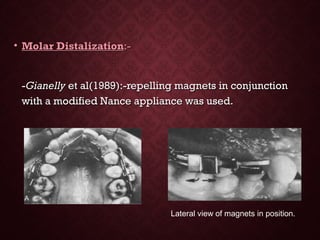 • Molar DistalizationMolar Distalization:-:-
--GianellyGianelly et al(1989):-repelling magnets in conjunctionet al(1989):-repelling magnets in conjunction
with a modified Nance appliance was used.with a modified Nance appliance was used.
Lateral view of magnets in position.
 