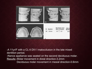 -A 11yr/F with a CL-II DIV I malocclusion in the late mixed
dentition period.
-Nance appliance was seated on the second deciduous molar.
Results:-Molar movement in distal direction-3.2mm
Deciduous molar movement in mesial direction-0.6mm
 