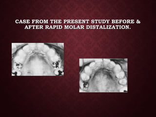 CASE FROM THE PRESENT STUDY BEFORE &CASE FROM THE PRESENT STUDY BEFORE &
AFTER RAPID MOLAR DISTALIZATION.AFTER RAPID MOLAR DISTALIZATION.
 