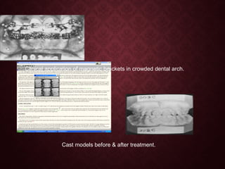 Clinical application of magnetic brackets in crowded dental arch.
Cast models before & after treatment.
 
