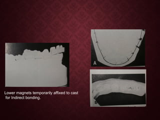 Lower magnets temporarily affixed to cast
for Indirect bonding.
 