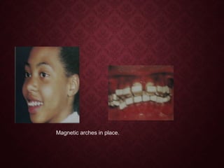 Magnetic arches in place.
 