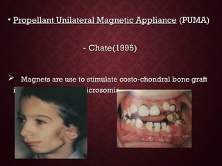 • Propellant Unilateral Magnetic AppliancePropellant Unilateral Magnetic Appliance (PUMA)(PUMA)
- Chate(1995)Chate(1995)
 Magnets are use to stimulate costo-chondral bone graftMagnets are use to stimulate costo-chondral bone graft
in Hemi facial microsomia.in Hemi facial microsomia.
 
