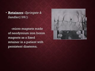 • RetainersRetainers:-:-Springate &Springate &
Sandler(1991)Sandler(1991)
-micro magnets made-micro magnets made
of neodymium iron boronof neodymium iron boron
magnets as a fixedmagnets as a fixed
retainer in a patient withretainer in a patient with
persistent diastema.persistent diastema.
 