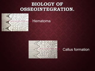 BIOLOGY OFBIOLOGY OF
OSSEOINTEGRATION.OSSEOINTEGRATION.
Hematoma
Callus formation
 