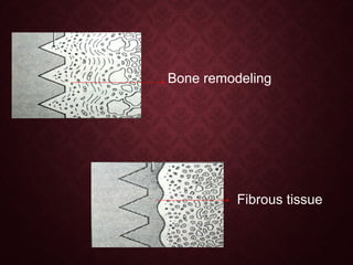 Bone remodeling
Fibrous tissue
 