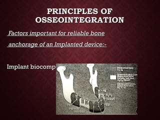 PRINCIPLES OFPRINCIPLES OF
OSSEOINTEGRATIONOSSEOINTEGRATION
Factors important for reliable boneFactors important for reliable bone
anchorage of an Implanted device:-anchorage of an Implanted device:-
Implant biocompatibility:-Implant biocompatibility:-
 