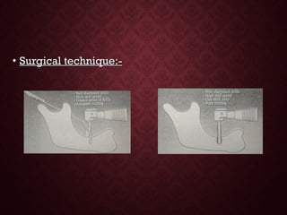 • Surgical technique:-Surgical technique:-
 