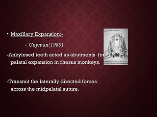 • Maxillary Expansion:-Maxillary Expansion:-
-- Guyman(1980)Guyman(1980)
-Ankylosed teeth acted as abutments for-Ankylosed teeth acted as abutments for
palatal expansion in rhesus monkeys.palatal expansion in rhesus monkeys.
-Transmit the laterally directed forces-Transmit the laterally directed forces
across the midpalatal suture.across the midpalatal suture.
 