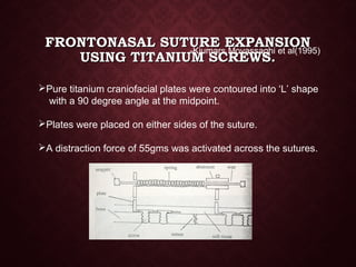 FRONTONASAL SUTURE EXPANSIONFRONTONASAL SUTURE EXPANSION
USING TITANIUM SCREWS.USING TITANIUM SCREWS.
-Kiumars Movassaghi et al(1995)
Pure titanium craniofacial plates were contoured into ‘L’ shape
with a 90 degree angle at the midpoint.
Plates were placed on either sides of the suture.
A distraction force of 55gms was activated across the sutures.
 