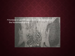 Increase in growth about 6mm was seen across
the frontonasal suture.
 