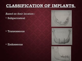 CLASSIFICATION OF IMPLANTS.CLASSIFICATION OF IMPLANTS.
Based on their locationBased on their location:-:-
• SubperiostealSubperiosteal
• TransosseousTransosseous
• EndosseousEndosseous
 
