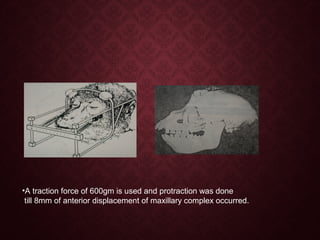 •A traction force of 600gm is used and protraction was done
till 8mm of anterior displacement of maxillary complex occurred.
 