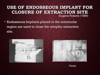 USE OF ENDOSSEOUS IMPLANT FORUSE OF ENDOSSEOUS IMPLANT FOR
CLOSURE OF EXTRACTION SITECLOSURE OF EXTRACTION SITE
• Endosseous Implants placed in the retromolarEndosseous Implants placed in the retromolar
region are used to close the atrophic extractionregion are used to close the atrophic extraction
site.site.
-Eugene Roberts (1989)
Pontic
 