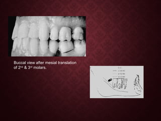 Buccal view after mesial translation
of 2nd
& 3rd
molars.
 