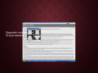 Diagnostic models,2.5yrs
Of post retention.
 