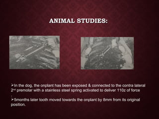 ANIMAL STUDIES:ANIMAL STUDIES:
In the dog, the onplant has been exposed & connected to the contra lateral
2nd
premolar with a stainless steel spring activated to deliver 110z of force
.
5months later tooth moved towards the onplant by 8mm from its original
position.
 