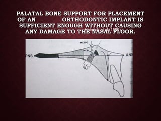 PALATAL BONE SUPPORT FOR PLACEMENTPALATAL BONE SUPPORT FOR PLACEMENT
OF AN ORTHODONTIC IMPLANT ISOF AN ORTHODONTIC IMPLANT IS
SUFFICIENT ENOUGH WITHOUT CAUSINGSUFFICIENT ENOUGH WITHOUT CAUSING
ANY DAMAGE TO THE NASAL FLOOR.ANY DAMAGE TO THE NASAL FLOOR.-Heinrich et al (1999)
 