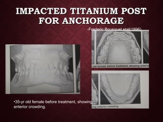 IMPACTED TITANIUM POSTIMPACTED TITANIUM POST
FOR ANCHORAGEFOR ANCHORAGE
-Frederic Bousquet etal(1996)
•35-yr old female before treatment, showing
anterior crowding.
 