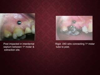 Post impacted in interdental
septum between 1st
molar &
extraction site.
Rigid .040 wire connecting 1st
molar
tube to post.
 
