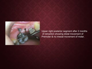Upper right posterior segment after 2 months
of retraction showing distal movement of
Premolar & no mesial movement of molar.
 