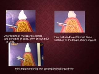 After raising of mucoperiosteal flap
and denuding of bone, 2mm of round bur
is used.
Pilot drill used to enter bone same
Distance as the length of mini-implant.
Mini-Implant inserted with accompanying screw driver.
 