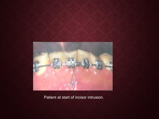Patient at start of incisor intrusion.
 