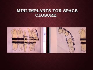 MINI-IMPLANTS FOR SPACEMINI-IMPLANTS FOR SPACE
CLOSURE.CLOSURE.
 
