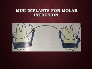 MINI-IMPLANTS FOR MOLARMINI-IMPLANTS FOR MOLAR
INTRUSIONINTRUSION
 