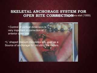 SKELETAL ANCHORAGE SYSTEM FORSKELETAL ANCHORAGE SYSTEM FOR
OPEN BITE CORRECTIONOPEN BITE CORRECTION-Umemori , Sugawara etal (1999)
• Control of vertical dimension is
very important in correction of
anterior open bite
•‘L’ shaped titanium miniplates are used as a
Source of anchorage for intruding the molars.
 