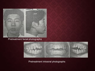 Pretreatment facial photographs
Pretreatment intraoral photographs
 