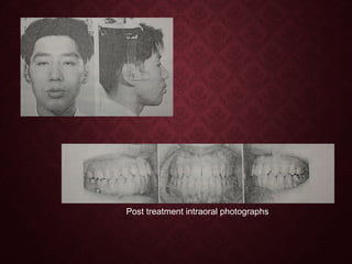 Post treatment intraoral photographs
 