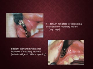 ‘Y’ Titanium miniplate for intrusion &
distalization of maxillary molars.
(key ridge)
Straight titanium miniplate for
Intrusion of maxillary incisors.
(anterior ridge of piriform opening).
 