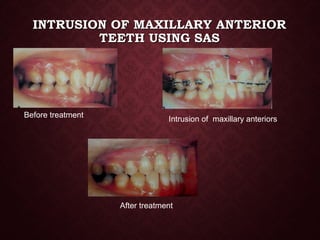 INTRUSION OF MAXILLARY ANTERIORINTRUSION OF MAXILLARY ANTERIOR
TEETH USING SASTEETH USING SAS
Before treatment
Intrusion of maxillary anteriors
After treatment
 