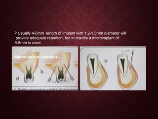 Usually 4-5mm length of implant with 1.2-1.3mm diameter will
provide adequate retention, but in maxilla a microimplant of
6-8mm is used.
Microimplant insertion:-
 