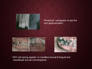 Periapical radiograph to see the
root approximation.
• NiTi coil spring applied to maxillary buccal & lingual and
mandibular buccal microimplants.
 